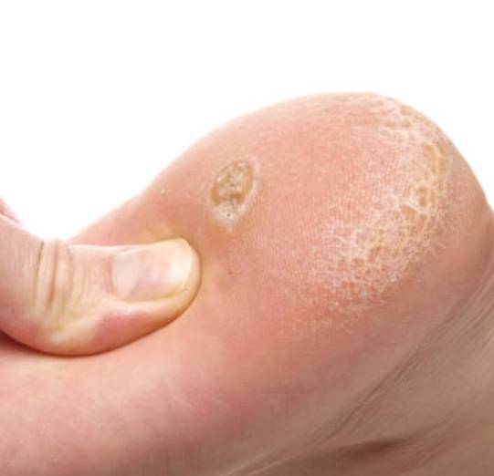 Imagen de Uña Encarnada